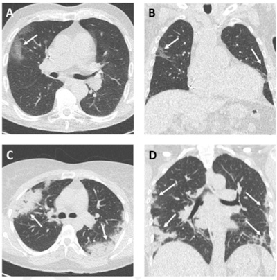 Example CT images in two patients with COVID-19