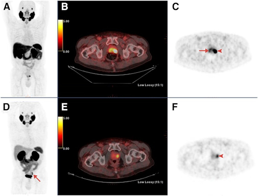 Maximum-intensity projections, transaxial fusion, and PET images of F-18-PSMA-1007 and Ga-68-PSMA-11 PET/CT scans from a 67-year-old patient