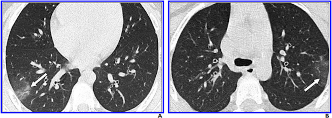 8-year-old boy with COVID-19. A and B, Unenhanced chest CT scans show minimal ground-glass opacification and no consolidation