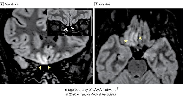 Brain MRI alterations in radiographer with COVID-19 who presenting with anosmia four days from symptom onset