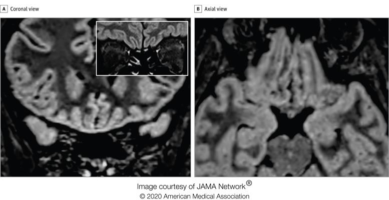 Follow-up MRI in the same patient 28 days from symptom onset