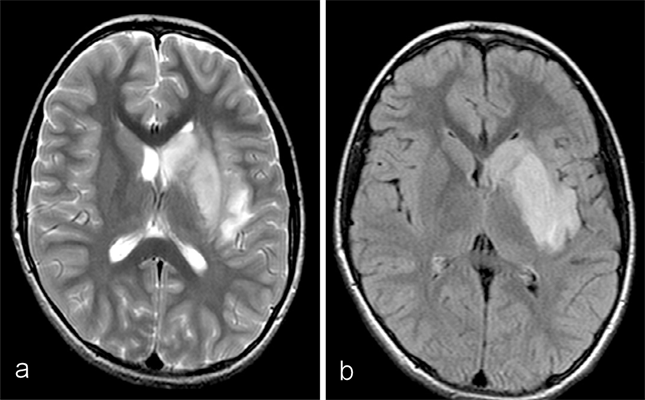 MRI demonstrated findings consistent with acute infarction without microhemorrhages, along with focal irregular narrowing and banding of the proximal M1 segment of the left middle cerebral artery with a slightly reduced distal flow
