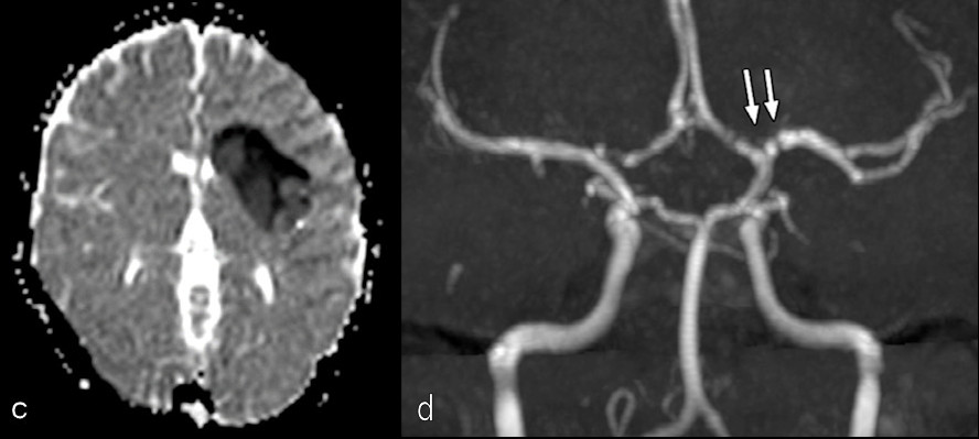 MRI demonstrated findings consistent with acute infarction without microhemorrhages, along with focal irregular narrowing and banding of the proximal M1 segment of the left middle cerebral artery with a slightly reduced distal flow