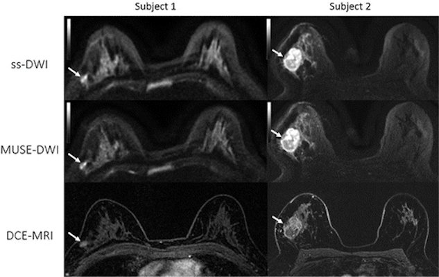 Comparison of single-shot DWI (ss-DWI), MUSE-DWI, and dynamic contrasted-enhanced (DCE-MRI) axial images for two patients with biopsy-proven invasive ductal carcinoma