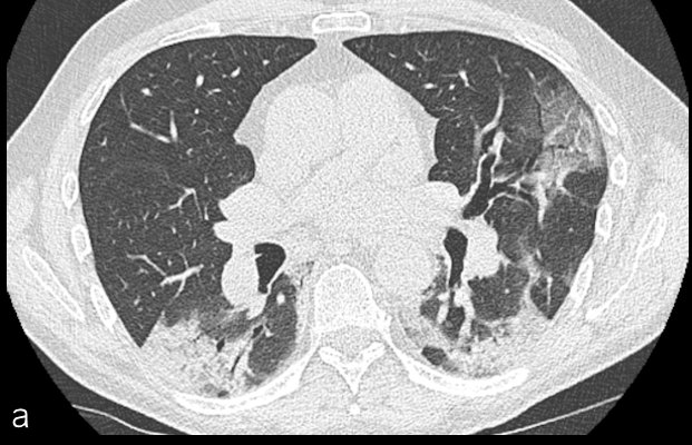 Unenhanced chest CT scan of a 61-year-old man presenting to the emergency department for fever and myalgia during nine days with new onset of dyspnea indicates typical COVID-19 pneumonia with mild lung involvement