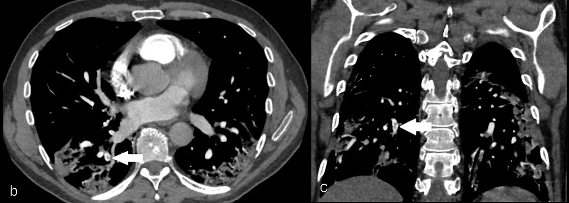 In the same patient, CTPA in axial and coronal reformation showed a segmental acute pulmonary embolism of the right lower lobe