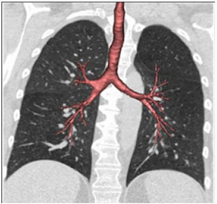 This CT scan of lung airways and lungs shows smaller airways in proportion to lung size