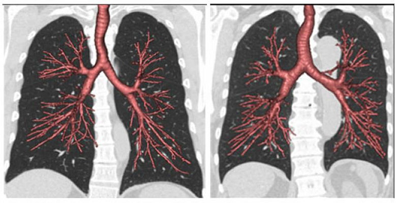 These CT scans of lung airways and lungs show normal size airways and larger than normal airways