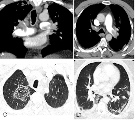 Images from a COVID-19-positive patient showing pulmonary embolism