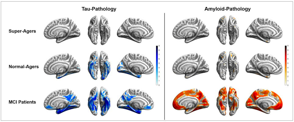 Tau and amyloid distribution patterns for super-agers, normal-agers, and MCI patients, who were compared to a group of younger, healthy, cognitively normal, amyloid-negative individuals