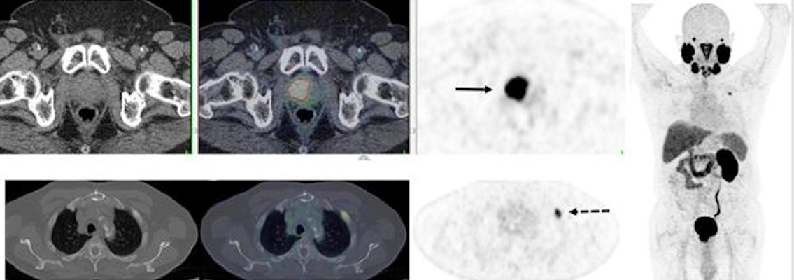 PSMA-PET/CT accurately detects recurrent prostate cancer in 67-year-old man