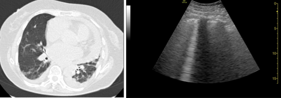 Septal thickening and pleural-pericardial effusion on CT. B-lines on ultrasound