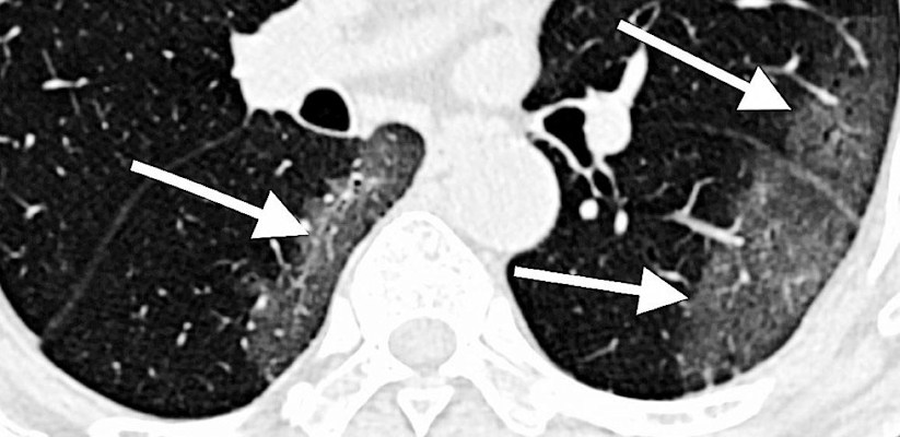 CT scan of lungs of COVID-19 patient with areas described by radiologists as resembling grains of ground glass