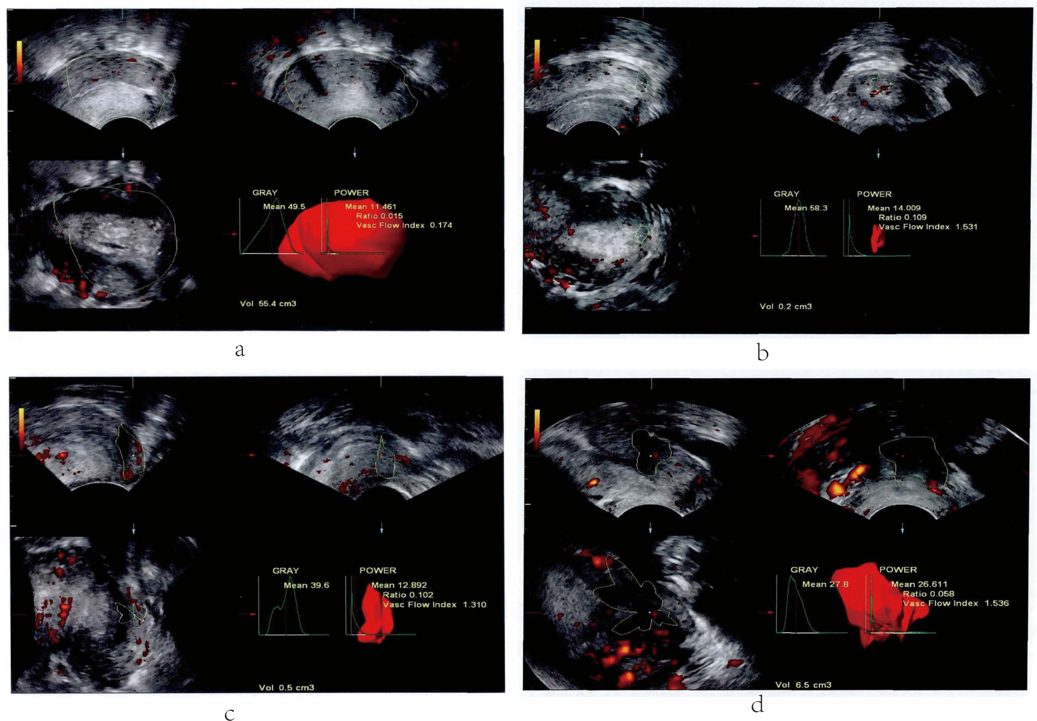 Doppler ultrasound images of cervical cancers with different Adler scores: (A) Grade 0, (B) Grade 1, (C) Grade 2, and (D) Grade 3.