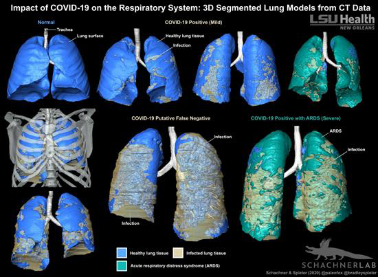 3D-segmented models of lung CT data show the distribution of COVID-19-related infection in the respiratory system