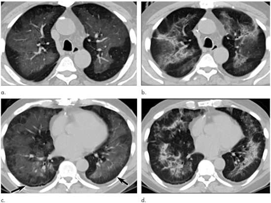Electronic cigarette or vaping product use-associated lung injury in a 51-year-old man manifesting as an acute lung injury pattern at CT with subsequent organization