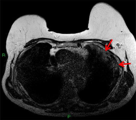 T2-weighted MRI depicting subpleural high T2 signal intensity