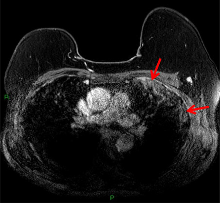 T1-weighted postcontrast fat-saturated MRI depicting subpleural consolidation enhancement