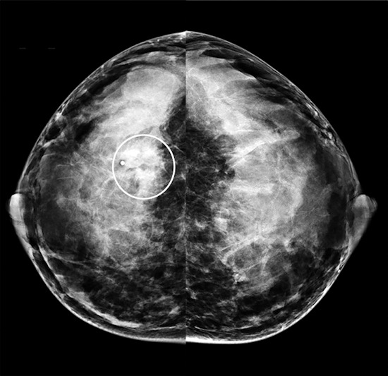 Craniocaudal mammogram from the same 40-year-old patient with invasive ductal carcinoma