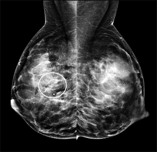 Mediolateral oblique mammogram from the same 40-year-old patient with invasive ductal carcinoma