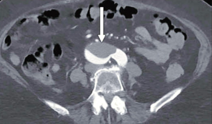 76-year-old woman who presented to emergency department with upper back pain. Axial abdominopelvic CT angiogram shows nonocclusive acute aortic thrombus