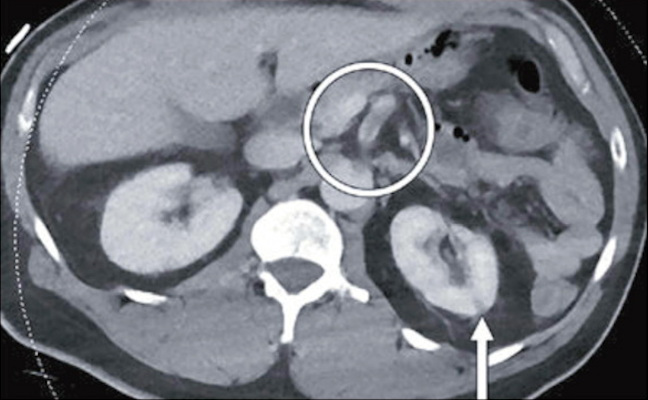 46-year-old man who was found to have COVID-19 after presenting with fever, shortness of breath, epigastric pain, and weakness. Axial contrast-enhanced abdominopelvic CT image shows small left renal infarct