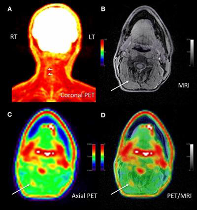 Adult male with decades of right neck pain, discomfort, and tightening following birth injury. The patient had failed multiple standard therapeutic maneuvers before presenting for F-18 FDG PET/MRI. Images show abnormally elevated FDG uptake