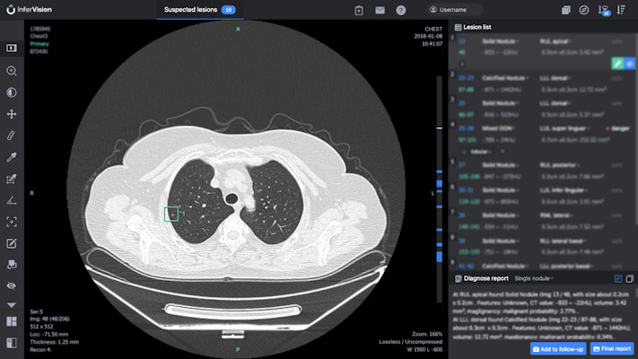 InferRead Lung CT.AI is designed to aid radiologists in detecting pulmonary nodules on chest CT