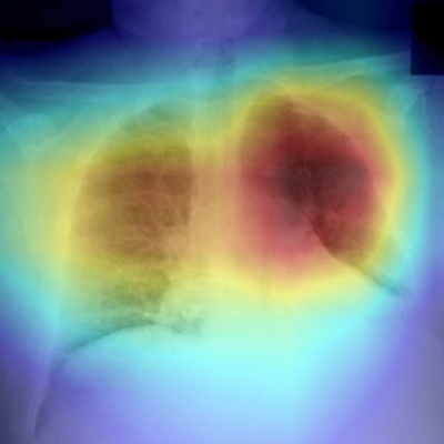Image shows heatmap generated by CV19-Net overlaid on original image
