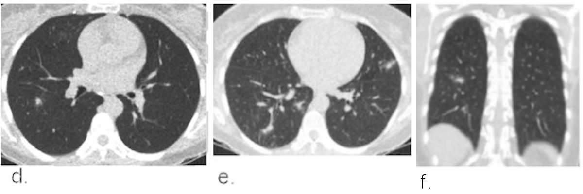 Example chest CT scans of a patient with a false-positive CO-RADS 4 score