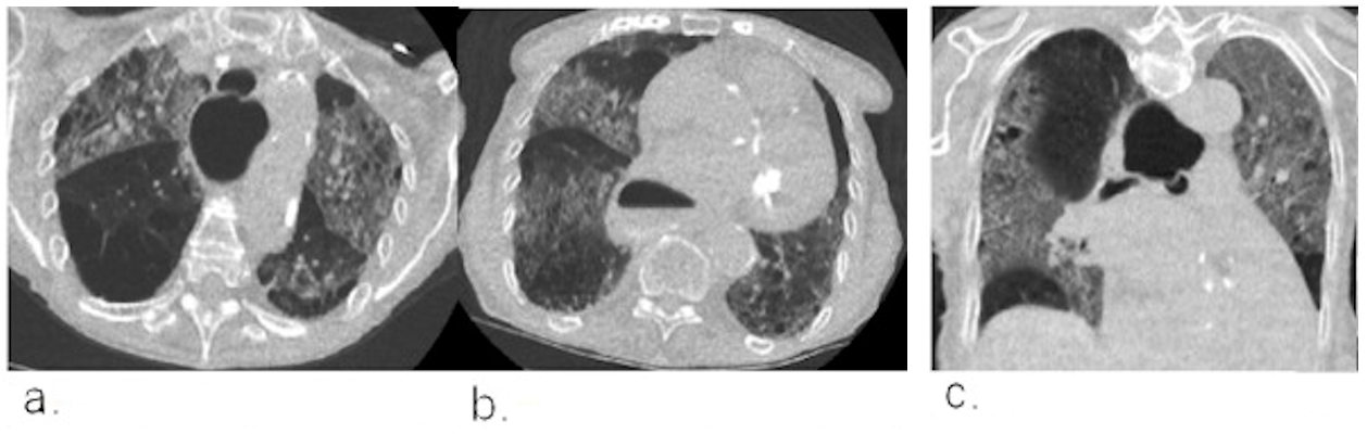 Example chest CT scans of a patient with a true-positive CO-RADS 4 score