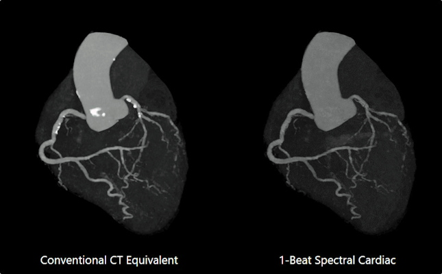 Image shows one-beat cardiac CT scan in deep-learning spectral mode. Spectral results demonstrate improved lumen visualization in presence of calcification