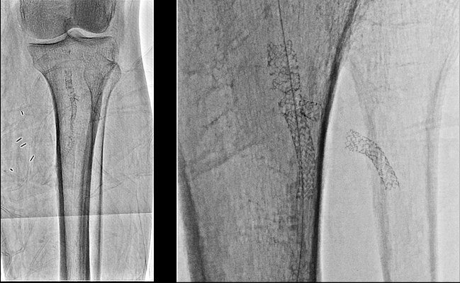 Image of a stent in popliteal and anterior tibial arteries: standard resolution with 12-inch field-of-view and Hi-Def resolution with 3-inch field-of-view