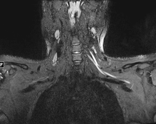 An MR image of a patient in their early 20s shows nerve injury of the left brachial plexus in the neck. The patient experienced left arm weakness and pain after recovering from COVID-19 respiratory illness, which prompted them to see their primary care physician