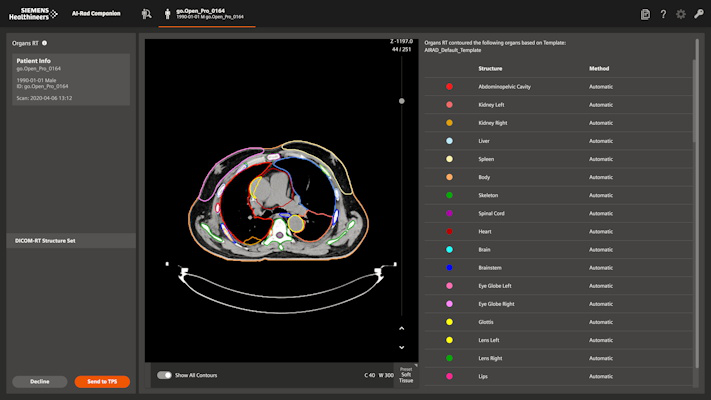 AI-Rad Companion Organs RT is an AI-based application for guiding radiation therapy treatment