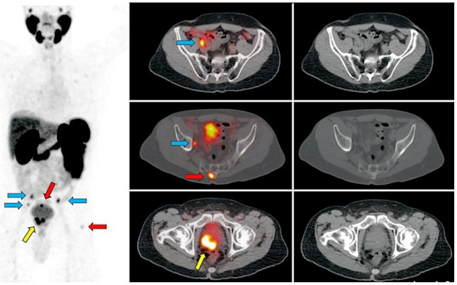 Ga-68 PSMA-11 PET/CT images of a patient with prostate cancer. Conventional imaging was negative for extraprostatic disease spread