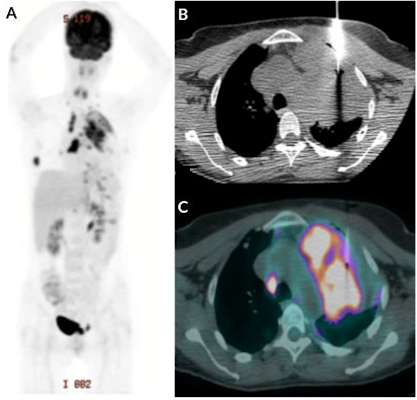 Images from a patient with lung mass who was referred for FDG-PET/CT