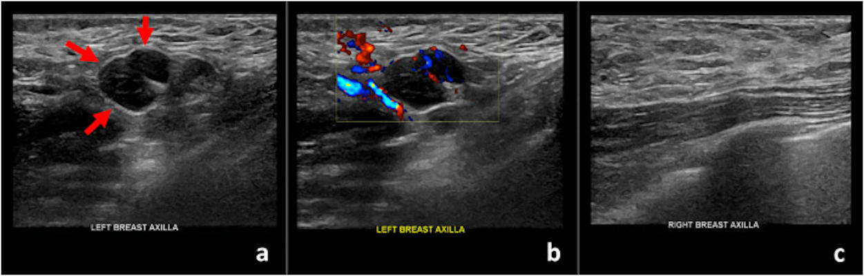 Ultrasound images of a 42-year-old patient who presented for sonographic follow-up of probably benign bilateral breast masses