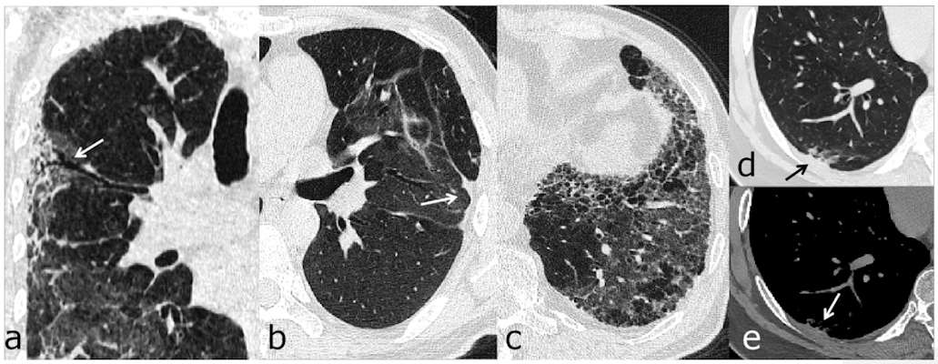 Chest follow-up CT findings of COVID-19 pneumonia