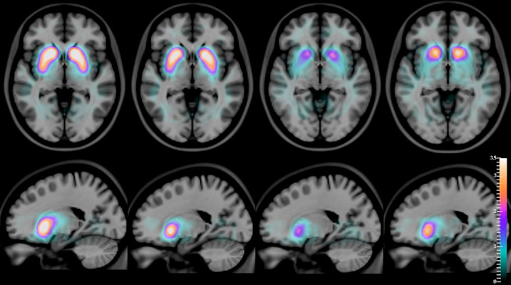 SPECT images, superimposed on an MR atlas, of an axial slice and a sagittal slice of the human brain, with a quantitative artificial-color scale showing the differences in the average distribution of the radioactive compound I-123 FP-CIT in the striatum of healthy controls, Alzheimer