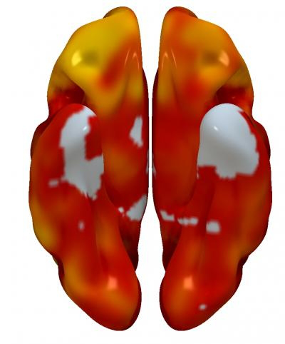 3D reconstructions of superior and inferior brain regions, showing regions with lower metabolism associated with the presence of atherosclerotic plaques in the carotid arteries