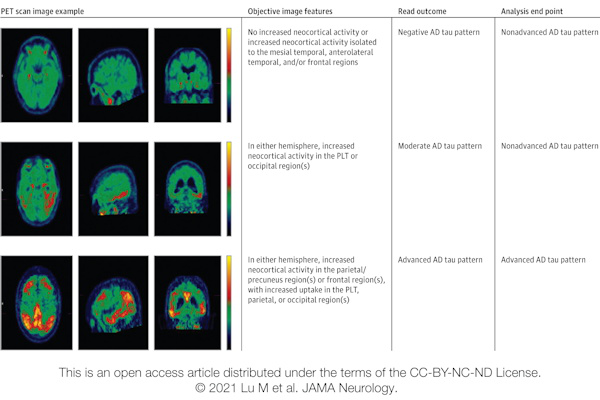 Image displays categories used in the visual interpretation of flortaucipir PET scans