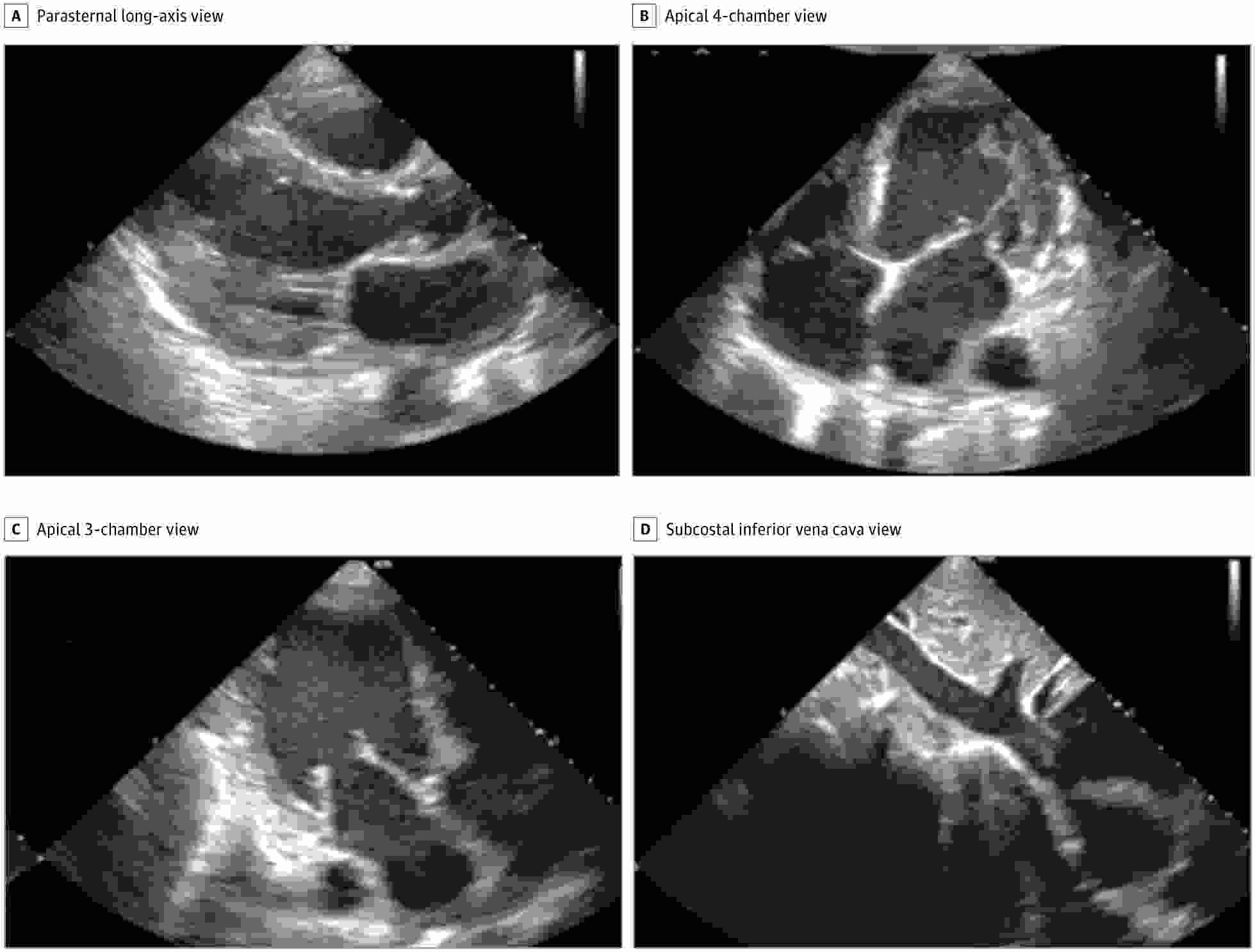 Still images of standard transthoracic echocardiographic views acquired by a nurse using the deep-learning algorithm were judged to be of diagnostic quality