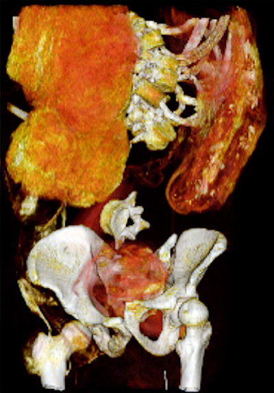 Coronal 3D CT image of lower torso of Seqenenre shows evisceration and embalming material within the abdomino-pelvic cavity