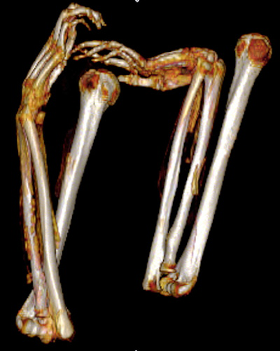3D frontal CT image of upper limbs of Seqenenre