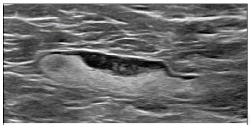 A 55-year-old woman who underwent screening mammogram and ultrasound seven days after her first COVID-19 vaccination dose