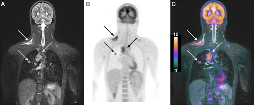 Coronal short tau inversion-recovery, FDG-PET, and FDG-PET/MRI fused images show how the hybrid modality detected right supraclavicular fossa and right paratracheal lymphadenopathy, as well as a right lung nodule, in a 14-year-old male with Hodgkin lymphoma