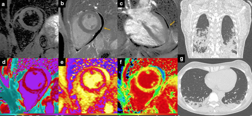 Pericarditis. 36-year-old in-hospital COVID-19 patient with chest discomfort and evidence of pericardial effusion at bedside echocardiography