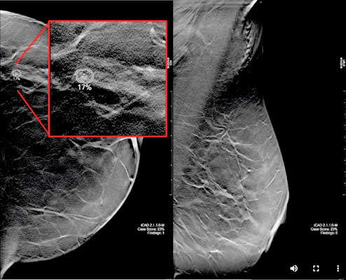 A 59-year-old woman with scattered density breasts