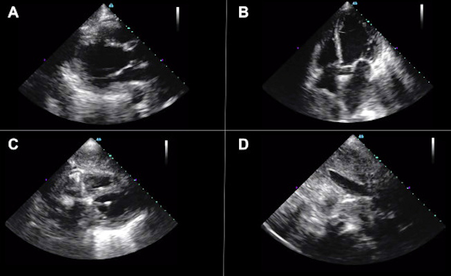 Bedside artificial intelligence-guided cardiac ultrasound revealed new severe left ventricular dysfunction